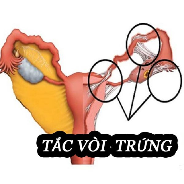 Tắc một bên vòi trứng có thai được không?